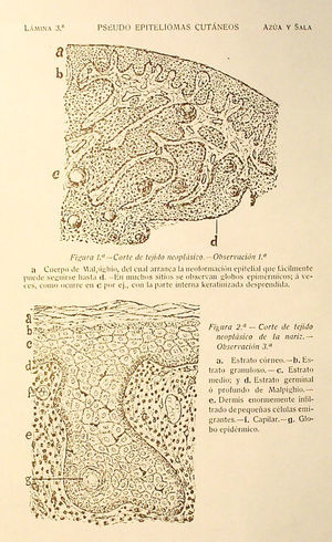 Grabado de la monografía de pseudoepiteliomas de Juan de Azúa y Claudio Sala en la que se ilustra la hiperplasia pseudoepiteliomatosa (la aportación más sobresaliente de este trabajo).