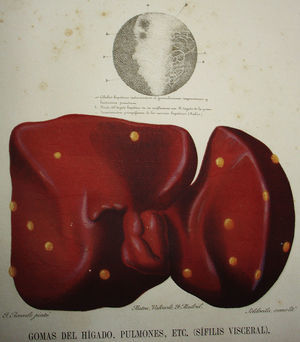 Fragmento de una lámina del Atlas… de Olavide en el que aparece la imagen de un hígado con gomas sifilíticos de una pieza de autopsia realizada por Federico Rubio. En la parte superior se puede ver un grabado histológico realizado sobre un dibujo del estudio histológico de la pieza.