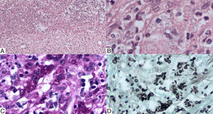 La biopsia de testículo muestra: A. Sustitución del parénquima testicular por inflamación crónica granulomatosa con células gigantes multinucleadas, zonas de necrosis e infiltrado de polimorfonucleares (HE, × 5). B. Acercamiento que muestra abundantes levaduras de forma ovoide (HE, × 40). C y D. Esporas esféricas y en forma de puros (PAS y Gomori Grocott, × 20).