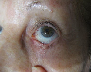 Carcinoma basocelular en borde palpebral del párpado inferior del ojo izquierdo; aspecto antes de iniciar el tratamiento.