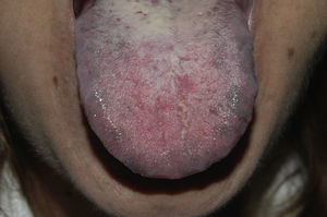 Pigmentación gris-azulada de la lengua, predominantemente en las áreas laterales del dorso lingual.