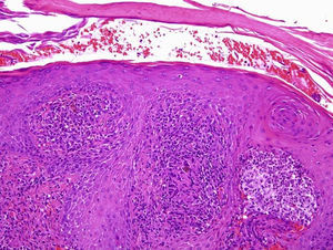 Hiperplasia seudoepiteliomatosa y presencia de esporas pigmentadas, «Cooper pennies» (6 a 12 micras)-Medlar bodies o Sclerotic bodies. (Hematoxilina-eosina, ×100).