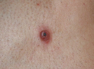 Pápula eritematosa con costra superficial, localizada en el hombro (caso 4).