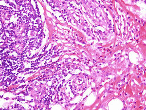 Infiltrado inflamatorio formado principalmente por eosinófilos y linfocitos rodeando las proliferaciones de luces vasculares (H-E ×400) (caso 1).