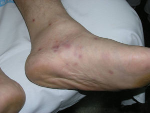 Case 2. Detail of erythematous papules.