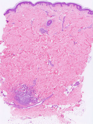 Case 3. The epidermis and the upper dermis are essentially unremarkable. Inflammatory cells are limited to the stroma surrounding the eccrine sweat glands (hematoxylin–eosin, original magnification 40×).