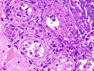 Case 3. A polymorphous dense neutrophilic, lymphocytic, and histiocytic infiltrate surrounding the eccrine secretory coils, leading to vacuolar degeneration and necrosis of eccrine epithelial cells (hematoxylin–eosin, original magnification 400×).