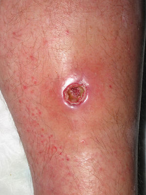 Borde eritematovioláceo y fondo fibrinoso tras el drenaje espontáneo de un absceso en la pierna.