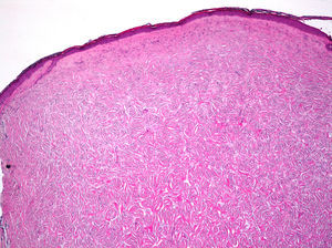 Lesión confinada a la dermis que muestra una disposición estoriforme de las células con presencia de colágeno hialinizado (caso 1) (H-E, ×4).