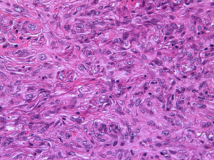 Detalle de las células epitelioides que muestran un citoplasma amplio y eosinófilo (caso 9) (H-E, ×40).