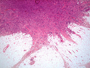Dermatofibroma extendiéndose al tejido celular subcutáneo (caso 13) (H-E, ×4).