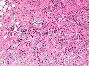 Las células del dermatofibroma atrapan haces de colágeno esclerótico (caso 18) (H-E, ×20).