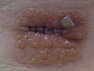 Dermatitis aguda por PVP-I que dibuja la morfología del apósito oclusivo utilizado tras la extirpación de un nevus en el quirófano de Dermatología (caso 4).
