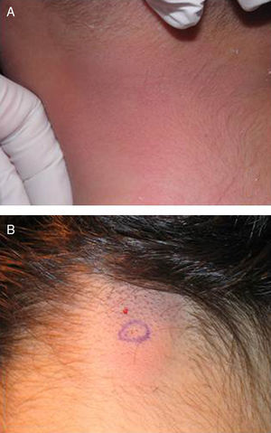 Imagen clínica de la tumoración en la nuca en el caso 1 (A) y en el caso 2 (B).