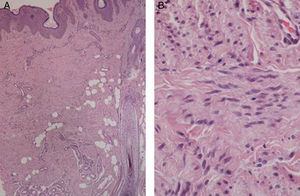 Imagen histopatológica (hematoxilina-eosina) del tumor a pequeño (×20) (A) y a gran aumento (×200) (B).