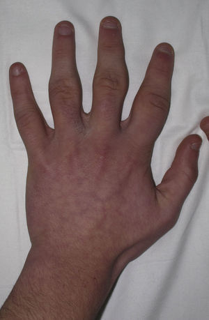 Imagen pretratamiento en la que se observa un engrosamiento difuso y muy marcado, localizado en las articulaciones interfalángicas proximales de todos los dedos de las manos, exceptuando los dedos 1° y 5°.