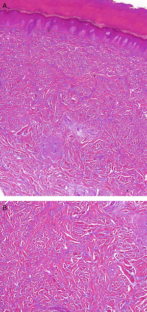 A. Imagen histológica en la que se observa un engrosamiento de la dermis con aumento tanto de las fibras de colágeno como en menor medida de los fibroblastos (Hematoxilina-eosina, x10). B. Imagen histológica ampliada en la que se puede observar el aumento de las fibras de colágeno y de los fibroblastos (Hematoxilina-eosina, x20).