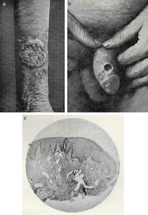Piodermitis crónicas. A. Piodermitis vegetante en un antebrazo. B. Imagen clínica de un caso de piodermitis chancriforme. C. Microfotografía de una piodermitis chancriforme.