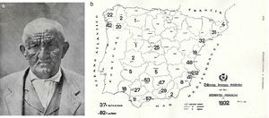 Lepra. A. paciente con facies leonina. B. Mapa de España con los casos oficiales de lepra en 1932; se advertían 3 focos peninsulares (noroeste, levantino y andaluz) y un foco extrapeninsular en Canarias.