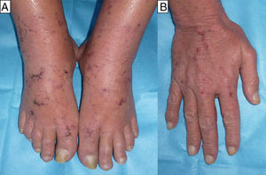 A y B. Lesiones erosivo-costrosas de disposición retiforme localizadas de forma bilateral y simétrica en dorso de las manos y de los pies.