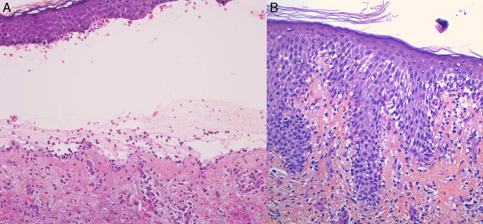 Penfigoide ampolloso: guía de manejo práctico | Actas Dermo-Sifiliográficas