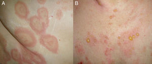 A. Lesiones urticariformes como presentación clínica en una paciente con penfigoide ampolloso. B. Ampollas tensas y erosiones aparecidas en la misma paciente en los días posteriores.