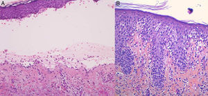 A. Ampolla subepidérmica con un infiltrado inflamatorio perivascular superficial mixto con abundantes eosinófilos (H-E ×210). B. Espongiosis eosinofílica (H-E ×210), patrón histológico observado frecuentemente en lesiones iniciales de penfigoide ampolloso.