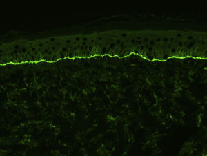 Depósitos lineales de C3 en la membrana basal, observados mediante inmunofluorescencia directa (×200) en la piel de un paciente con penfigoide ampolloso.