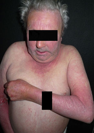 Lesiones eritemato-descamativas de predominio en zonas fotoexpuestas (cara, «V» del escote, dorso de los brazos y de las manos) en un paciente con fotosensibilidad por hidroclorotiazida.