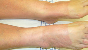 Lesiones maculosas eritematosas que afectan a las piernas y al dorso de los pies de una paciente con fotosensibilidad por hidroclorotiazida. Obsérvese el límite neto con la piel sana que estaba cubierta por el zapato.