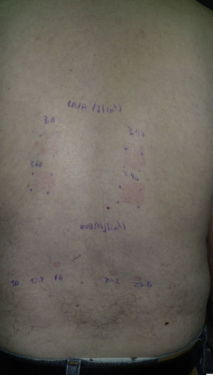 Fototest de un paciente con fotosensibilidad por hidroclorotiazida. La UVA (zona superior) se realizó con un PUVA 181-AL y la UVB (zona inferior) con un simulador solar. Se observa una reacción anómala a UVA y que la DEM-UVB está disminuida.