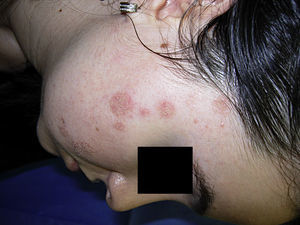Faint erythematous and eroded impetiginized patches on the right cheek and temple.