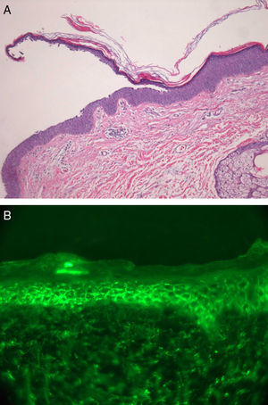 (a) Superficial acantholysis and hyperchromatic nuclei in the granular layer (hematoxylin–eosin, original magnification ×20) and (b) DIF at 40× magnification displaying segmental intercellular staining for IgG and C3.