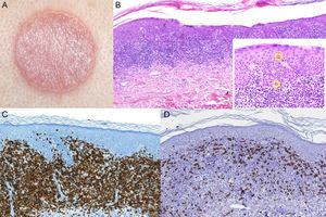 A. Placa eritematosa interescapular. B. La biopsia cutánea revela un infiltrado linfocitario en banda con epidermotropismo claro (H-E ×4). Se observan linfocitos con halo permeando la misma. (H-E ×20). C y D. Tinciones inmunohistoquímicas que demuestran el predominio de linfocitos T CD4+.