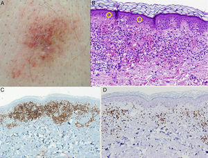 A. Placa purpúrica lumbosacra. B. La tinción con hematoxilina-eosina (H-E ×20) muestra una importante extravasación eritrocitaria, así como numerosas figuras de linfocitos en halo en la epidermis. C. Predominio de linfocitos CD4+ en el infiltrado inflamatorio (×10). D. Escasos linfocitos CD8+ (×10).