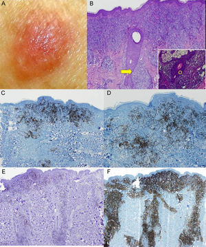 A. Tumoración carnosa, normocoloreada. B. La biopsia muestra un infiltrado epidermo y foliculotropo (H-E ×4), así como linfocitos que permean el folículo (recuadro inferior derecho H-E ×40). C y D. Las tinciones inmunohistoquímicas revelan la existencia de una rica celularidad B acompañante (CD20 y CD79 ×4). E y F. Observamos que el infiltrado linfocitario está compuesto en su práctica totalidad de linfocitos CD4+ que acompañan a los folículos pilosos.