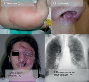 Estadios de Schöbinger.