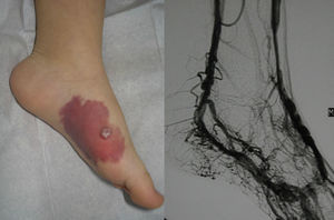 Nodularidad de reciente aparición sobre una malformación capilar. MAV.