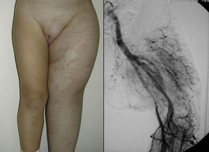 Síndrome Parkes-Weber (hipertrofia generalizada de una extremidad asociada a una MAV).