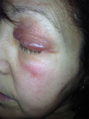 Edema palpebral de 24h de evolución no caliente ni doloroso y más acentuado en lado derecho.