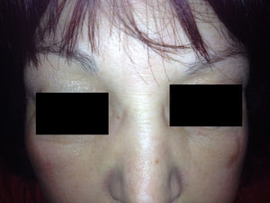 Edema bipalpebral a las 72h desde el inicio, que infiltra la raíz nasal.