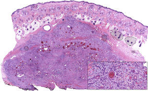 Carcinoma espinocelular moderadamente diferenciado (H-E×10). En el recuadro se muestra con mayor detalle cómo el tumor está compuesto por nidos y cordones de células epiteliales, con extensos focos de diferenciación queratósica (H-E×400).