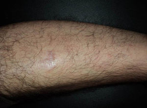 Resolución tras 3 inyecciones, una semanal, de rituximab intralesional (10mg/ml).