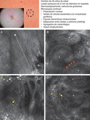 Presentación clínica y dermoscópica del carcinoma basocelular pigmentado. A. Imagen de microscopia confocal reflectante (MCR) (0,5×0,5mm) tomada de una profundidad de aproximadamente 30μm bajo la superficie cutánea. Se observa una elongación de los núcleos en el mismo eje («polarización nuclear», línea). B. Imagen (MCR 0,5×0,5mm) en la que se aprecian islotes tumorales con «empalizada periférica» característica (astericos) y despegamiento del estroma (e). C y D. Asimismo, en su vecindad se aprecian vasos dilatados (flechas) y en su interior melanocitos dendríticos brillantes. Imágenes MCR 0,5×0,5mm que revelan la presencia de tumor (asterisco) con dendritas intratumorales (flecha amarilla). En el interior del estroma (e) se observan agregados de melanófagos (flechas blancas).