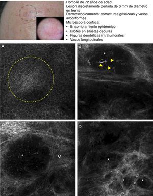 Presentación clínica y dermoscópica del carcinoma basocelular. A. Imagen (0,5×0,5mm) de la zona inferior de la epidermis presentando ensombrecimiento epidérmico (círculo discontinuo). B. Imagen (0,5×0,5mm) de la dermis donde se aprecian los islotes tumorales no refráctiles en patrón denominado dark silhouette. En su interior destaca la presencia de células dendríticas (cabezas de flecha) que parece corresponder a melanocitos intratumorales. C. Imagen (MCR 0,5×0,5mm) en la dermis donde se aprecia islote tumoral (asterisco) no refráctil en patrón denominado dark silhouette rodeado por estroma refráctil (e). En su interior destaca la presencia de un particulado refráctil, posiblemente melanina. D. Imagen (MCR 0,5×0,5mm) en la dermis profunda donde se aprecian islotes tumorales (asterisco) no refráctiles de menor tamaño.