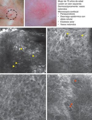 Presentación clínica y dermoscópica del carcinoma de células escamosas in situ. A. Imagen (0,5×0,5mm) del estrato córneo evidenciado numerosas células poliédricas altamente brillantes (cabeza de flechas). B. Imagen (0,5×0,5mm) del estrato granuloso presentando un patrón en panal atípico con desarraigo arquitectural y células atípicas (flechas). C. Imagen (0,5×0,5mm) del estrato espinoso presentando desarraigo arquitectural importante. D. Imagen (0,5×0,5mm) de la dermis revelando elastosis solar(es) y vasos redondos (cabezas de flecha).
