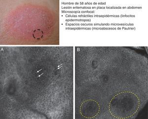 Presentación clínica de lesión de micosis fungoides tipo placa. A. Imagen (0,5×0,5mm) del estrato espinoso superficial revelando disrupción y presencia de células brillantes (epidermotropismo, flechas blancas) entre los queratinocitos. B. Imagen (0,5×0,5mm) del estrato espinoso revelando pequeños espacios oscuros que se corresponden con microabscesos de Pautrier (círculo discontinuo). En su interior se observan células intensamente refráctiles que se corresponden con linfocitos atípicos.