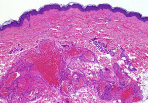 Estudio histológico de una de las lesiones maternas con presencia de una neoformación vascular en la dermis profunda con grandes luces vasculares revestidas por células glómicas (hematoxilina-eosina ×40).