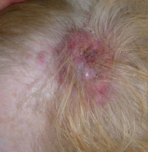 Lesión tumoral eritematoviolácea de 4cm de diámetro y con lesiones maculares periféricas.