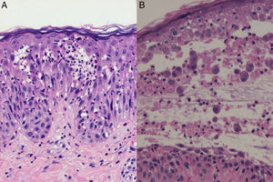 A. Espongiosis neutrofílica en la epidermis con algún eosinófilo aislado (H-E×400). B. Vesícula acantolítica en la capa media de la epidermis que también se acompaña de neutrófilos y eosinófilos.